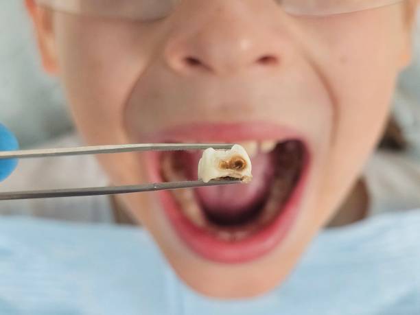 Best Emergency Wisdom Teeth Removal in Deer Park, WA